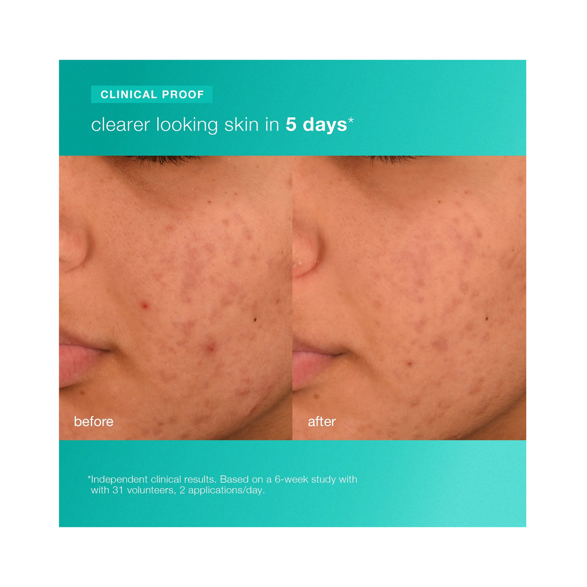 Dermalogica_Acne_Biotic_Moisturizer_1.7oz / 1.7OZ, image 30125420675222