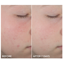 Dr. Dennis Gross Alpha Beta On The Spot Eliminator / 1OZ