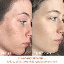 Dr. Dennis Gross Alpha Beta Universal Daily Peel 5 Pk / 5PK