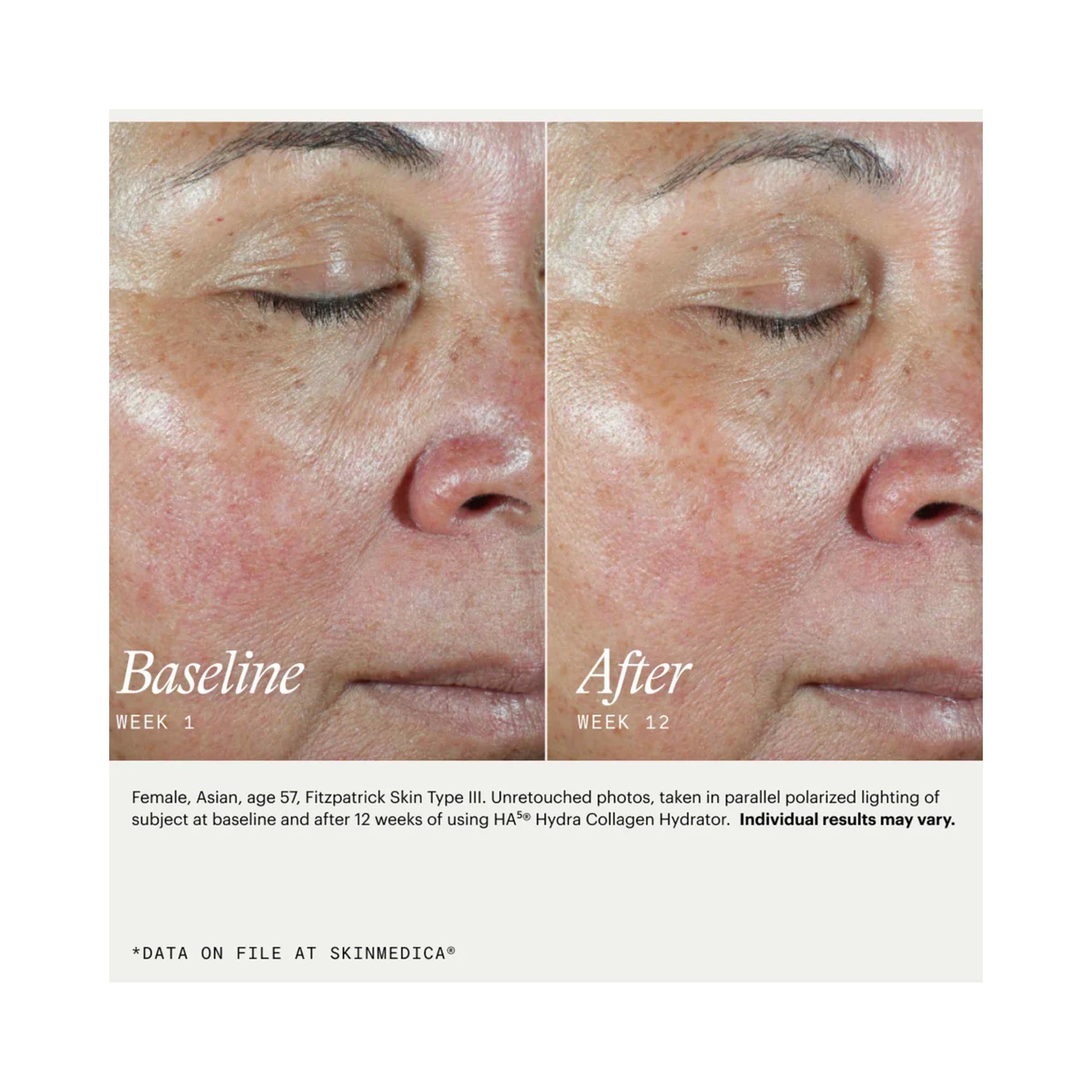 SkinMedica HA5 Hydra Collagen Facial Mist / 3.4OZ