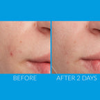 Kate Somerville EradiKate Acne Treatment / 1 OZ