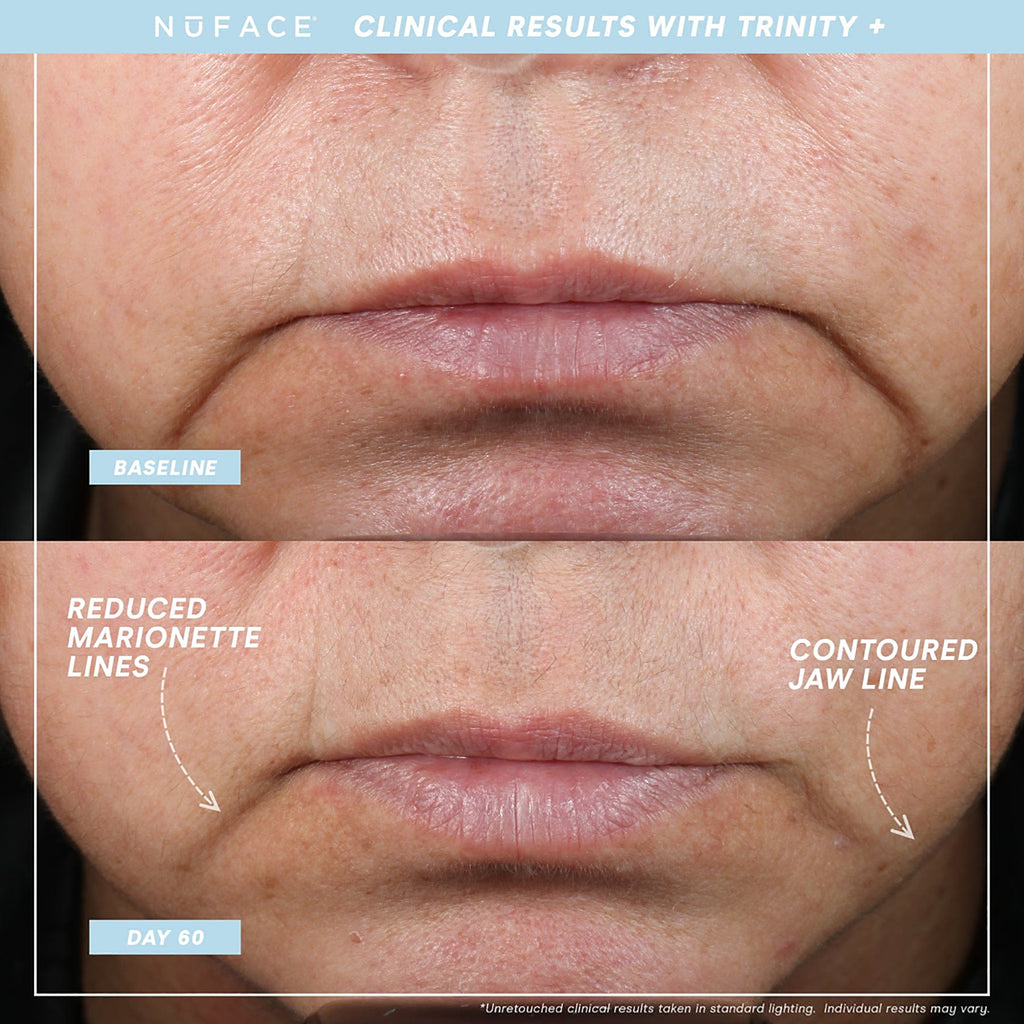 NuFace Trinity+ WITH Effective Lip & Eye Attachment Kit / KIT thumbnail 4