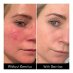 Omnilux Contour Face