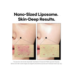 Before-and-after close-up of a person's cheek and mouth area showing skin texture and redness, with text reading 'Nano-Sized Liposome. Skin-Deep Results.