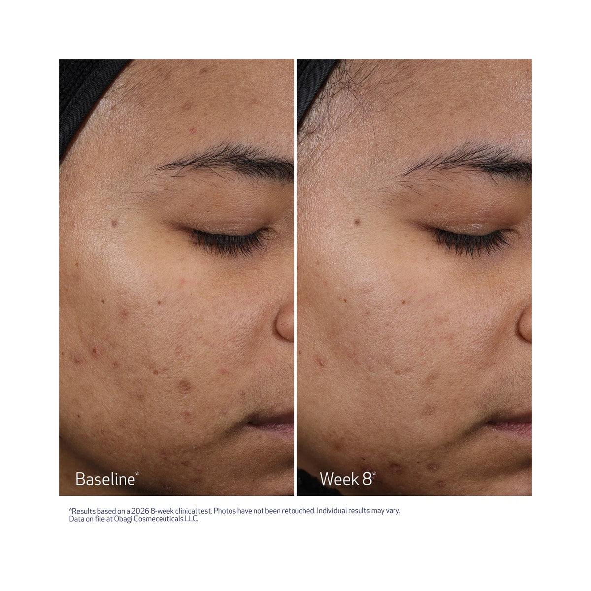 Obagi Clenziderm M.D. Resurfacing Multi-Acid Peel Pads, before and after image after 8 weeks, image 46265622790294