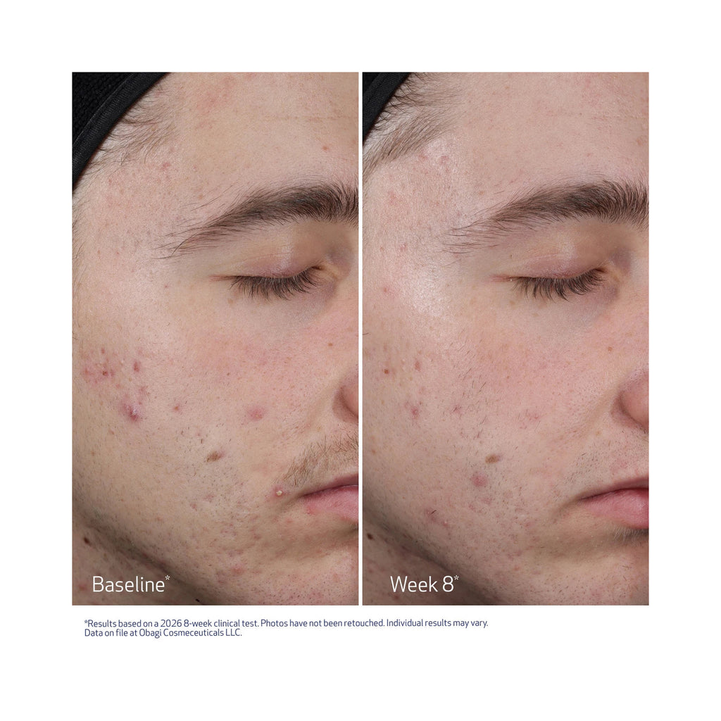 Obagi Clenziderm M.D. Resurfacing Multi-Acid Peel Pads, before and after image after 8 weeks thumbnail 5