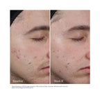Obagi Clenziderm M.D. Resurfacing Multi-Acid Peel Pads, before and after image after 8 weeks