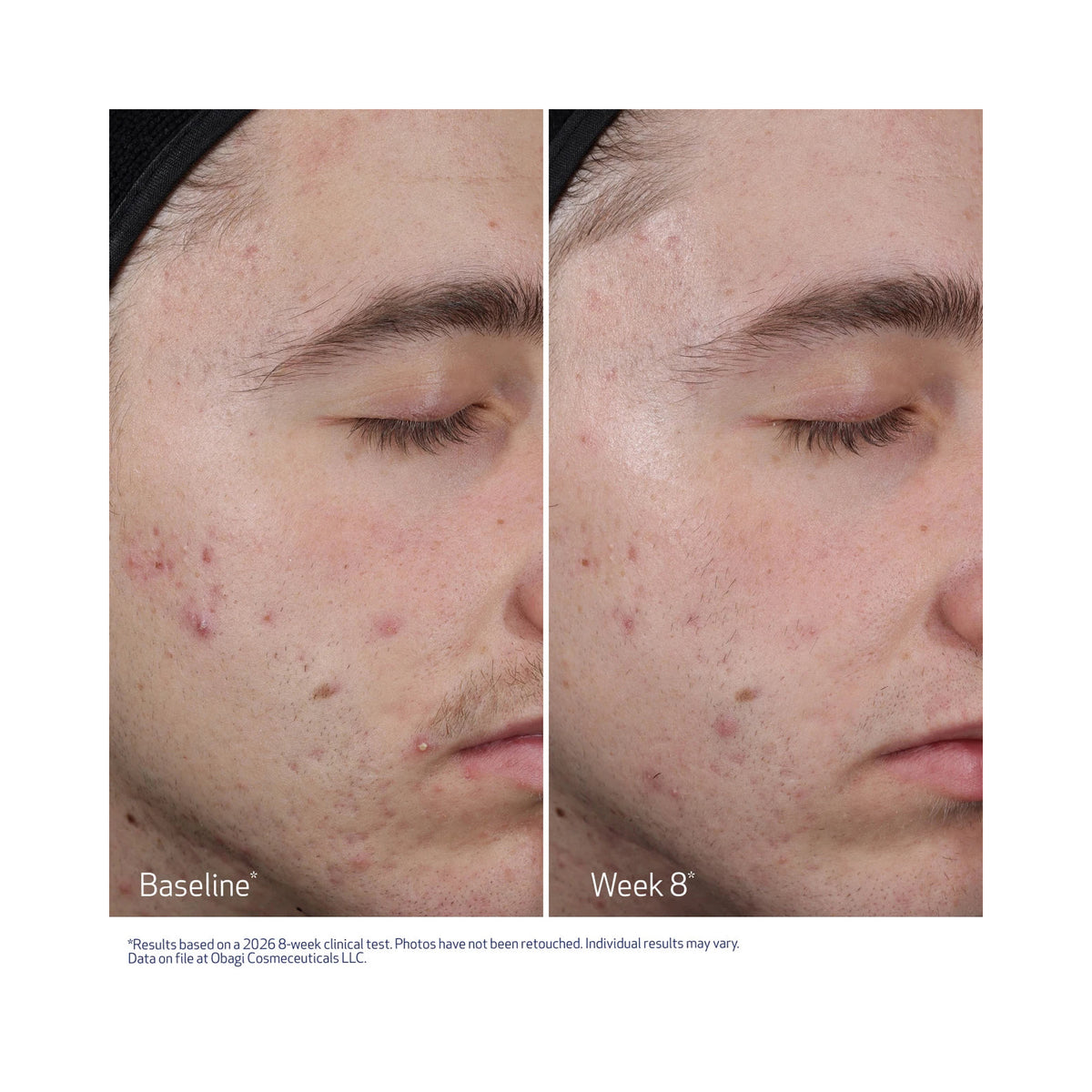 Obagi Clenziderm M.D. Resurfacing Multi-Acid Peel Pads, before and after image after 8 weeks, image 46265622823062