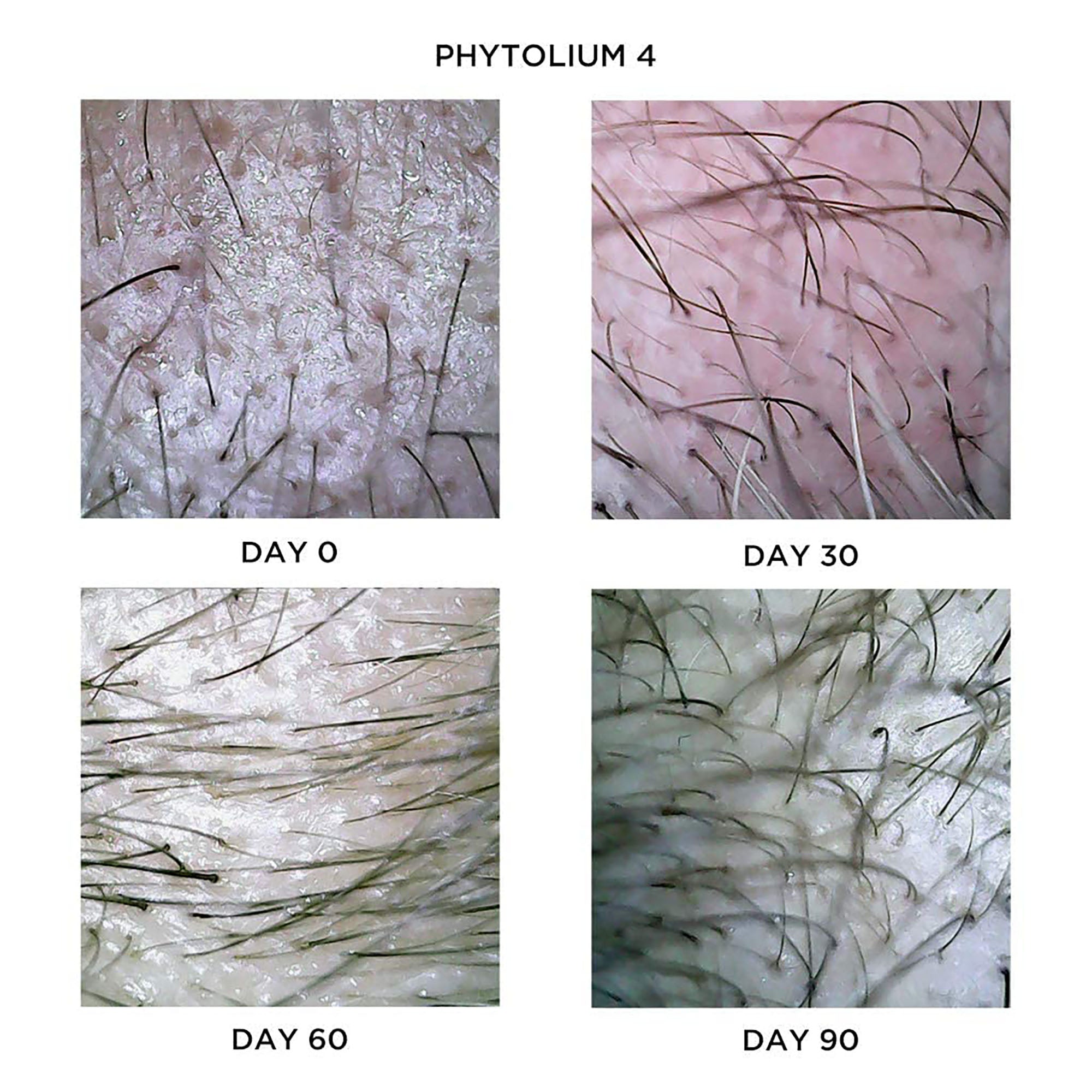 Phyto Phytolium 4 Chronic Thinning Hair Treatment / 12 PACK