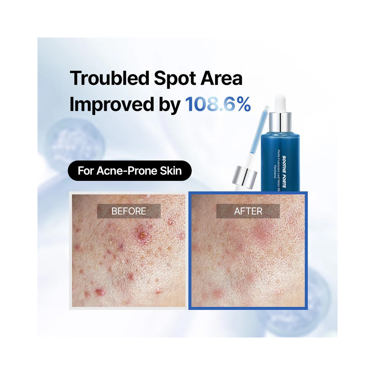 Essenciel Soothe Forte Ampoule, before and after results for acne-prone skin, image 46267795472534