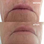 Wrinkle Schminkles Mouth & Lip Wrinkle Patches - 2pc