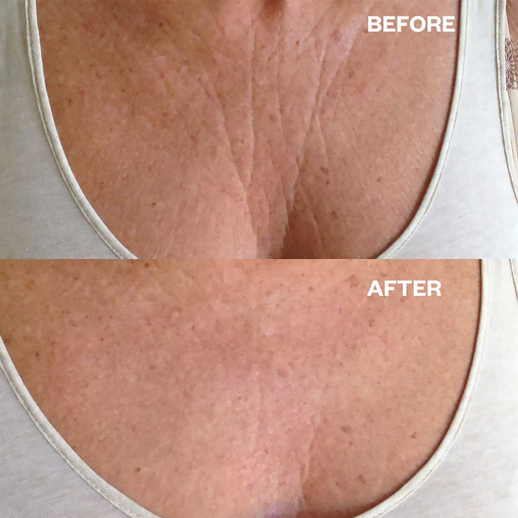 Wrinkles Schminkles Chest Wrinkle Patch thumbnail 3