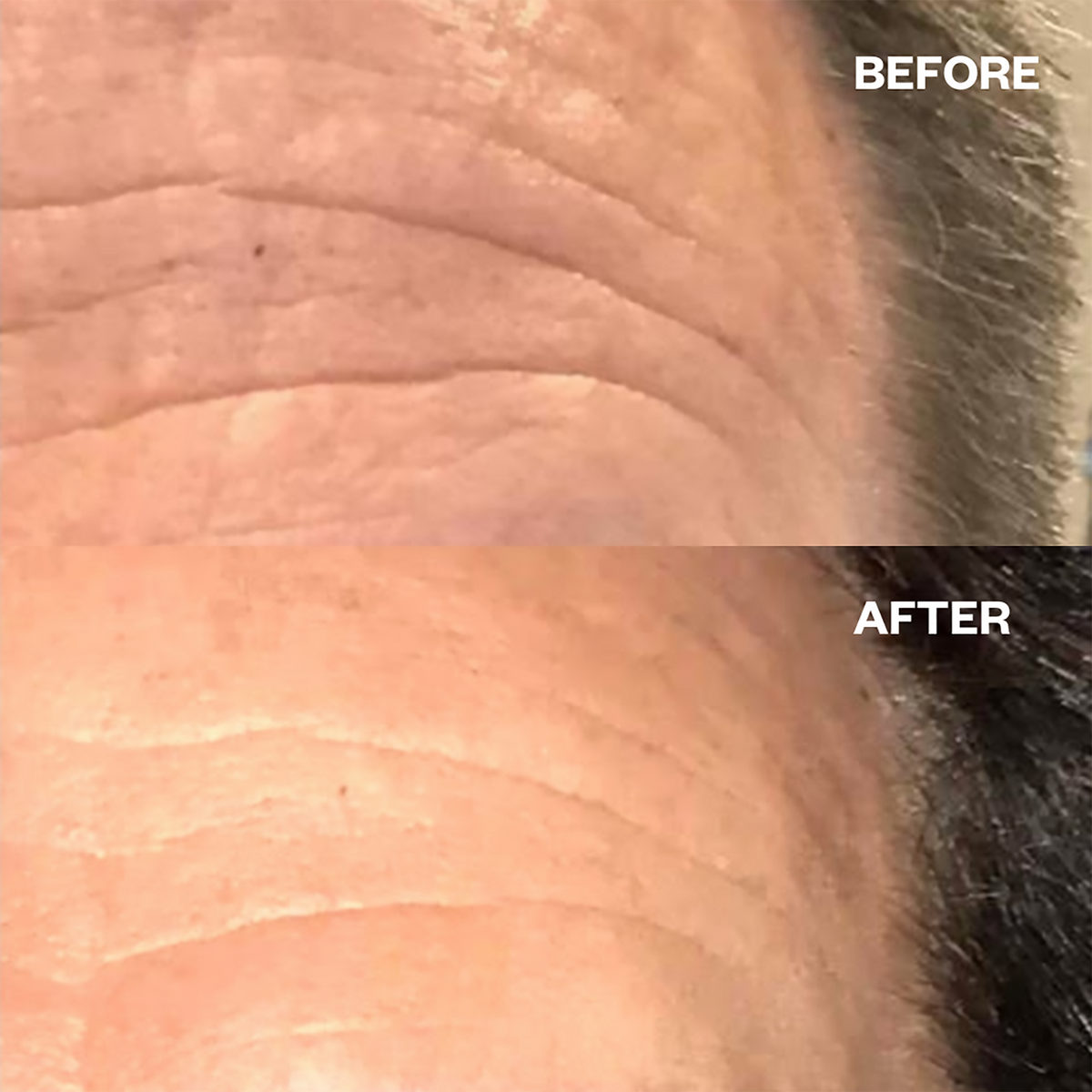 Wrinkles Schminkles Forehead Wrinkle Patches - 2pk, image 27415798022294