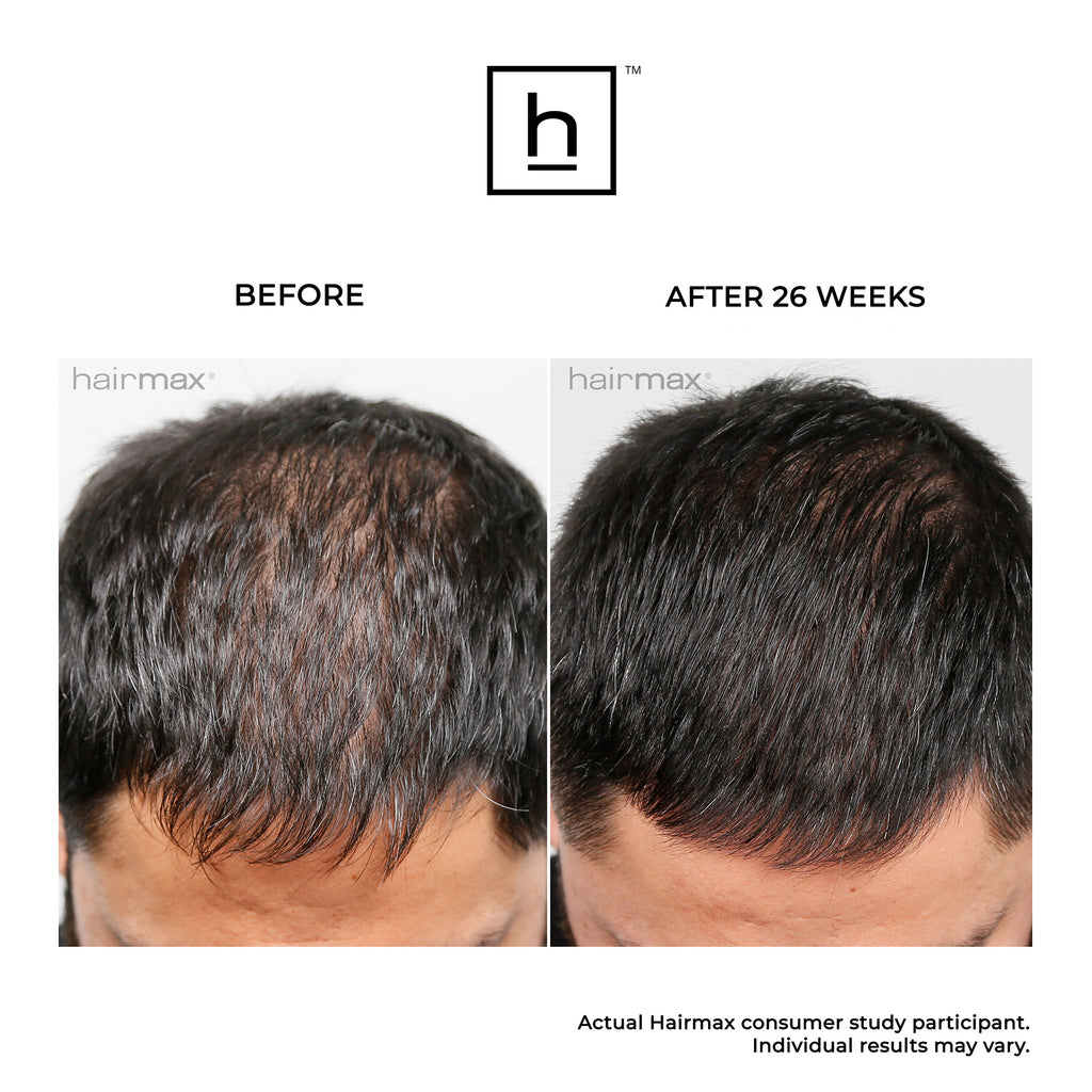 Hairmax LaserBand 82 ComfortFlex Hair Growth Device / 82 ComfortFlex thumbnail 9