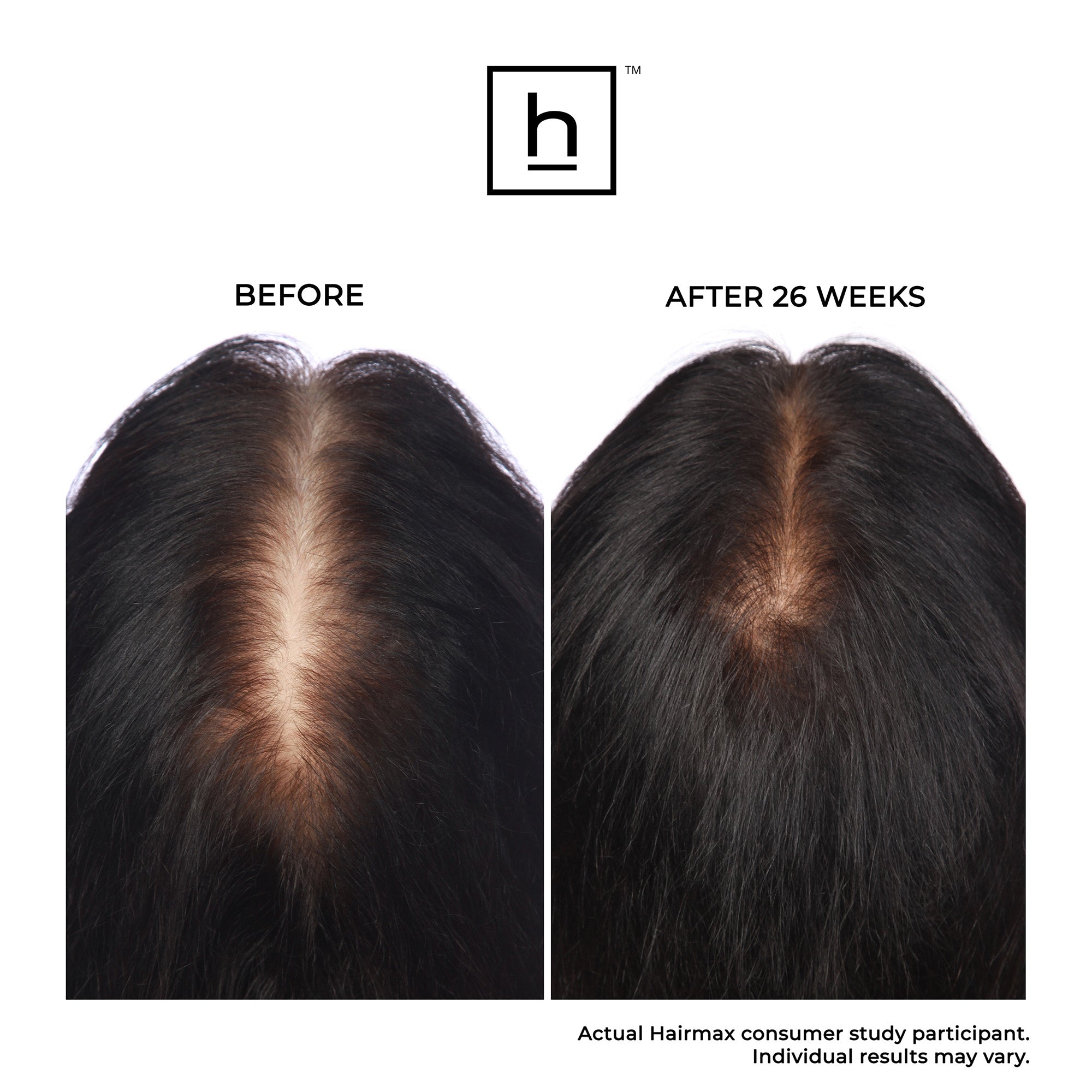 Hairmax Ultima 12 LaserComb Hair Growth - Planet Beauty