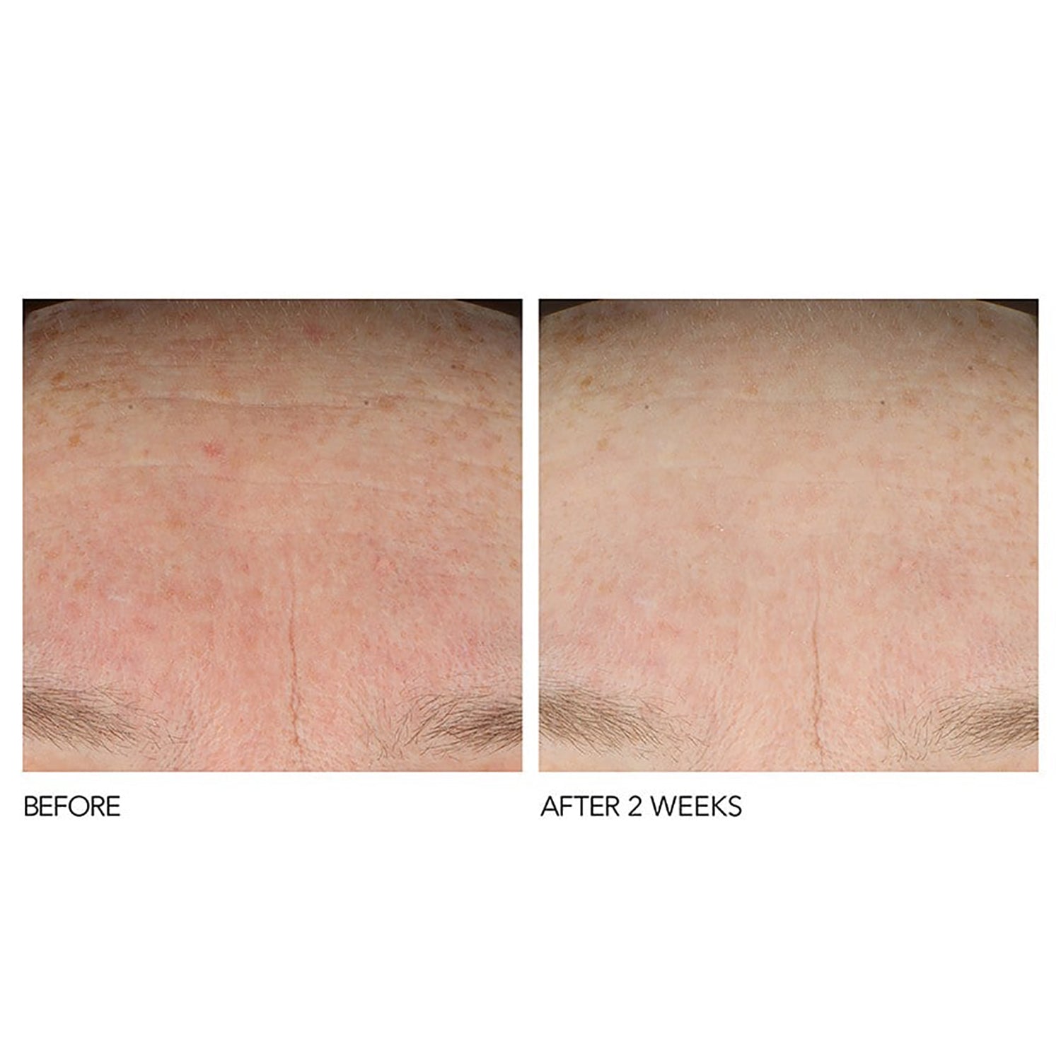 Dr. Dennis Gross B3Adaptive Stress Rescue Super Serum with Niacinamide Before & After 2 weeks